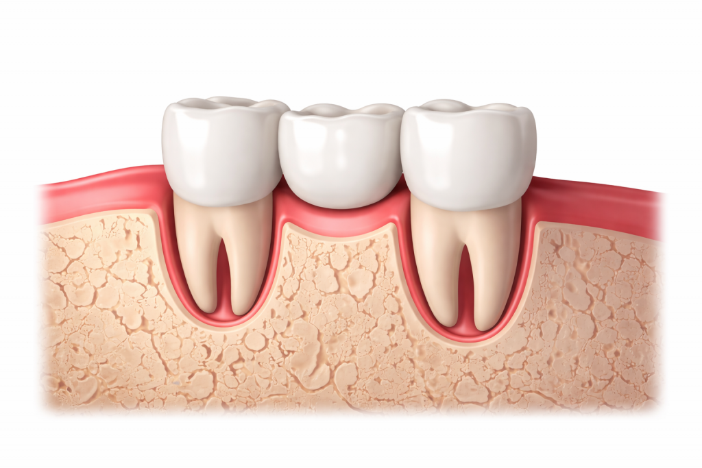Illustration d’un bridge dentaire avec une dent artificielle soutenue par deux dents piliers