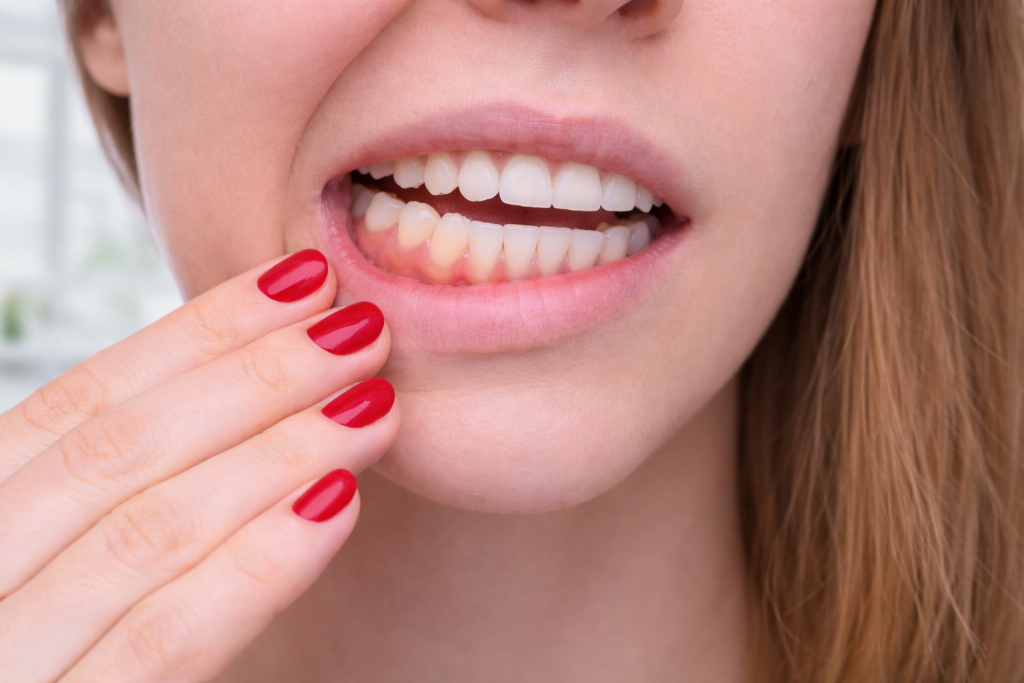 gencive qui saigne femme inflammation gingivale légère