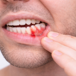 gencive qui saigne chez un homme inflammation gingivale légère