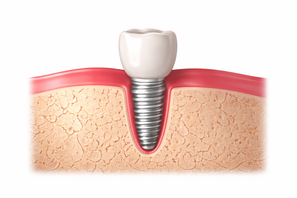 Illustration d’un implant dentaire avec vis en titane intégrée dans l’os et couronne dentaire