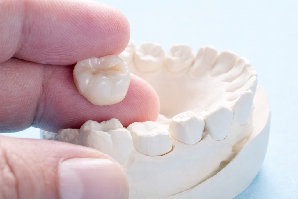 prix couronne dentaire France couronne céramique sur modèle dentaire