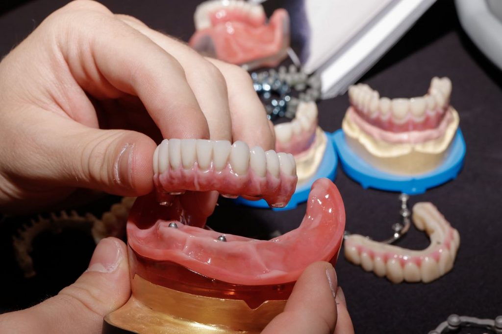 prothèse dentaire complète sur implants type all-on-4 manipulée sur un modèle de mâchoire