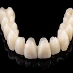 prothèse complète All-on-6 en zircone sur implants