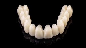 prothèse complète All-on-6 en zircone sur implants