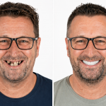 avant après prothèse complète All-on-6 en zircone sur implants dentaires