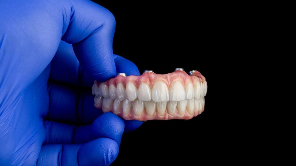 Bridge sur implants