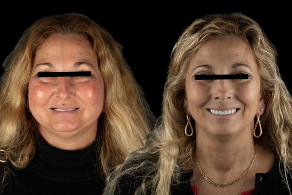 Chirurgie dentaire esthétique avant après