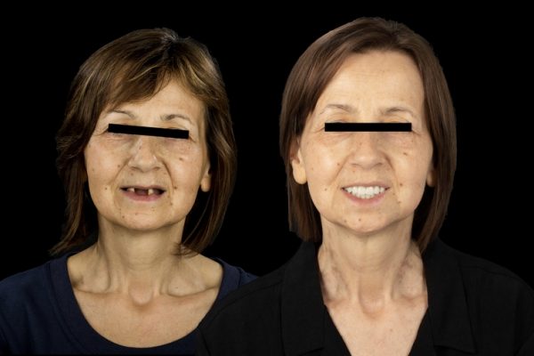 Sourire transformé à l'étranger