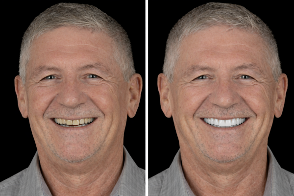 Avant après traitement All on 4 avec soins dentaires réalisés en Europe