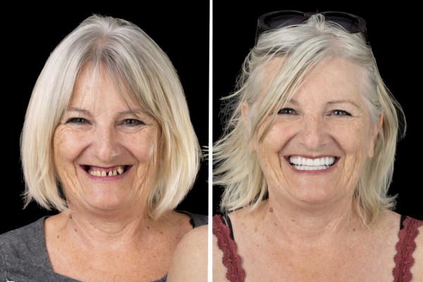 Avant après dents restaurées dans une clinique dentaire partenaire en Europe