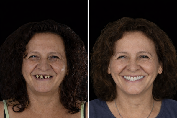 Avant après pose d’une prothèse dentaire fixe stabilisée sur implants