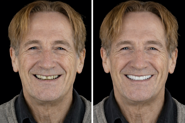 Avant après sourire restauré grâce à des implants dentaires réalisés à l’étranger