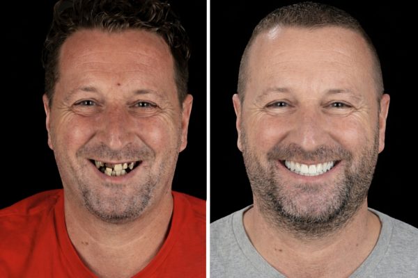 Avant après sourire d’un patient accompagné dans un parcours de tourisme dentaire